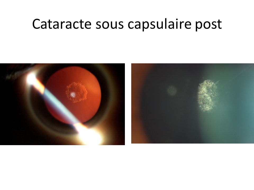 cataracte-sous-capsulaire